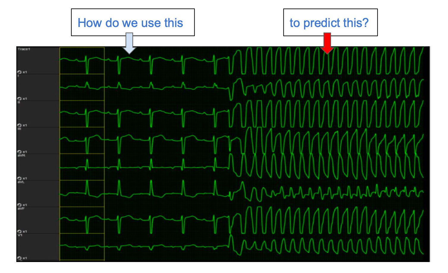 ECG Cardiac Arrest Prediction Task